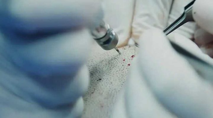 زرع الشعر بالاقتطاف