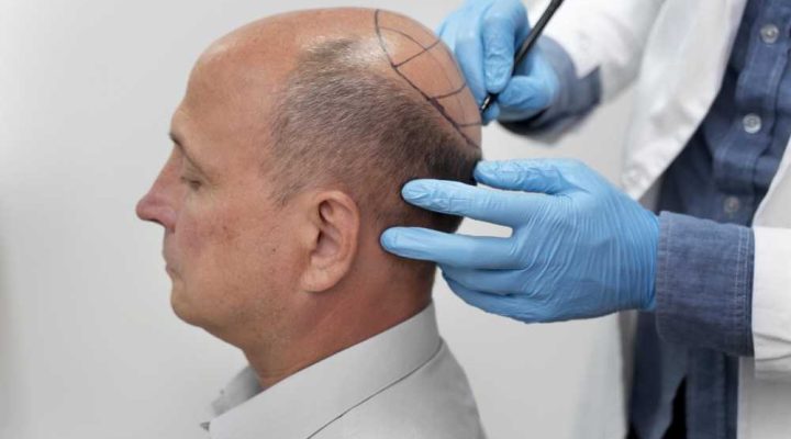 طريقة زراعة الشعر بالاقتطاف