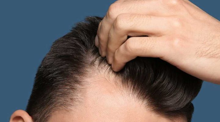 فراغات بعد زراعة الشعر