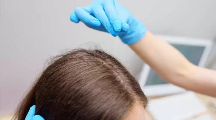 تحاليل تساقط الشعر