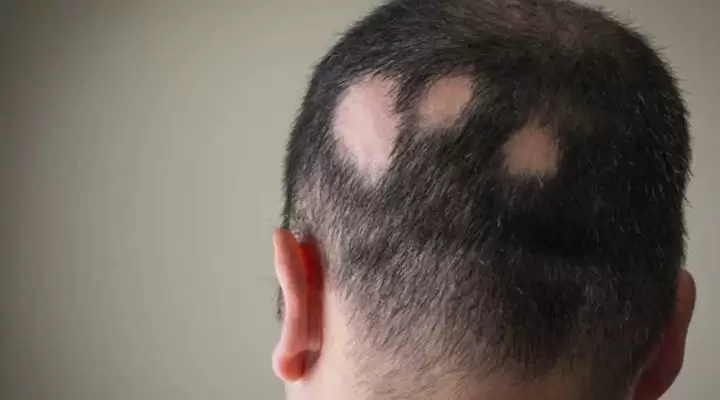 علاج للثعلبة