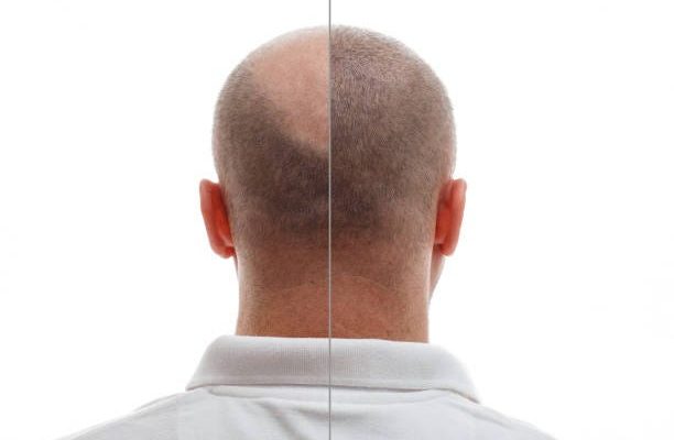 زراعة الشعر بالرياض