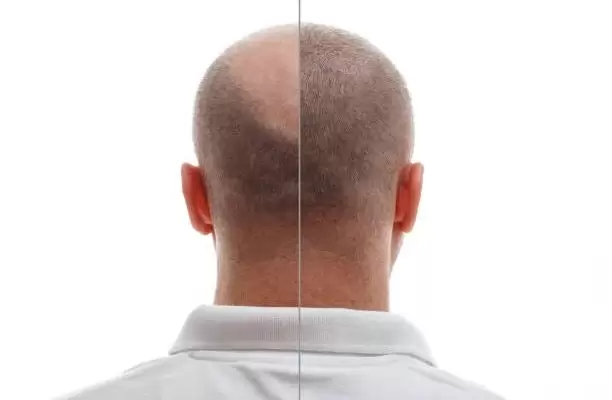 زراعة الشعر بالرياض