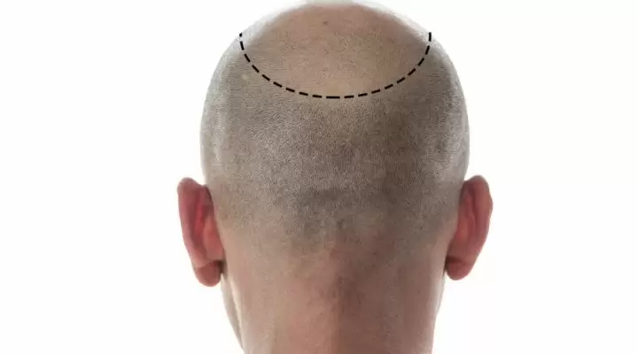 شكل الرأس بعد زراعة الشعر