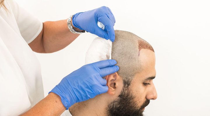 أفضل كريم بعد زراعة الشعر