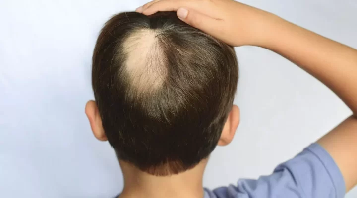 علاج الثعلبة من الصيدلية