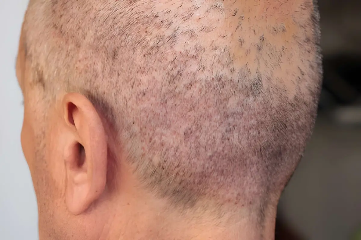 التهاب المنطقة المانحة بعد الزراعة وأهم 5 نصائح لعلاجه 3 نمو الشعر في المنطقة المانحة