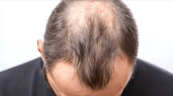 زراعة شعر بالخلايا الجذعية