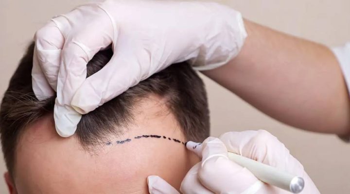 تكلفة زراعة الشعر 2025