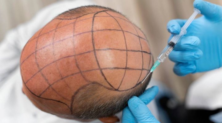 تكلفة زراعة الشعر في مصر 2024