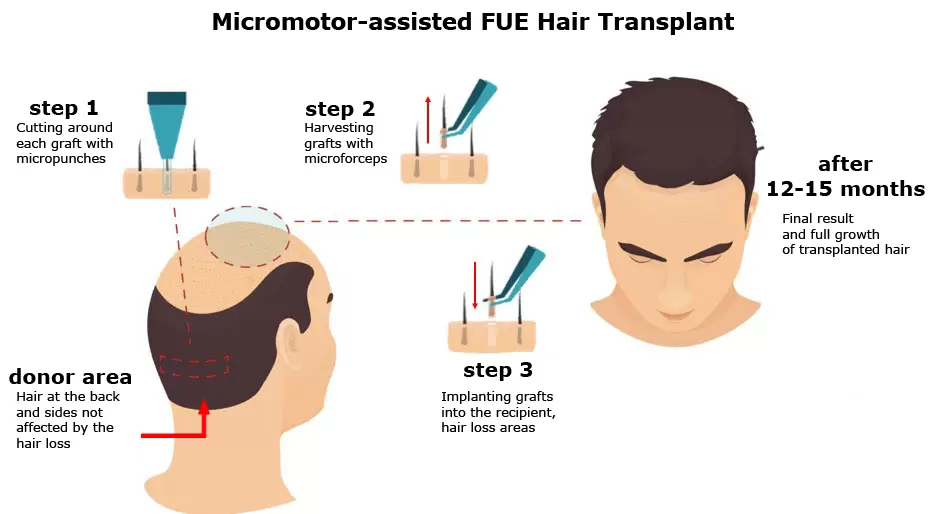 خطوات زراعة الشعر