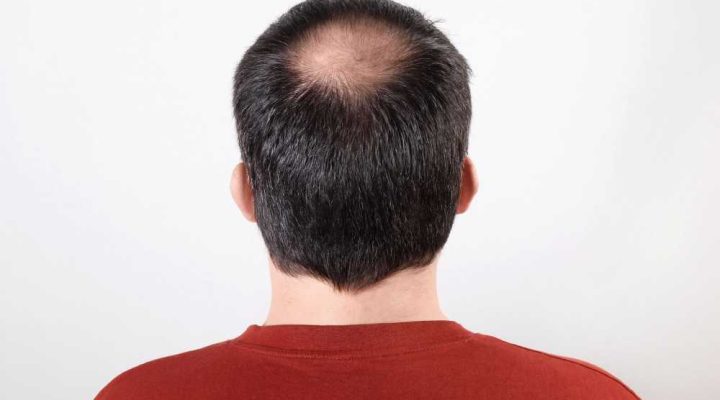علامات فشل زراعة الشعر