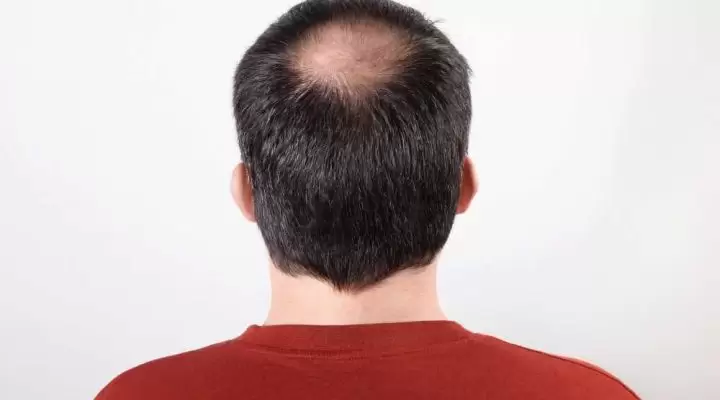 علامات فشل زراعة الشعر