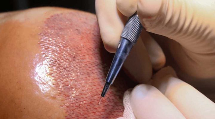 قلم السفير لزراعة الشعر