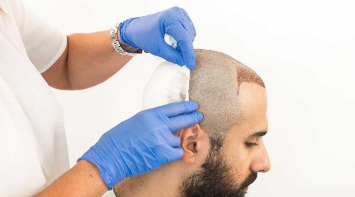 بعد زراعة الشعر