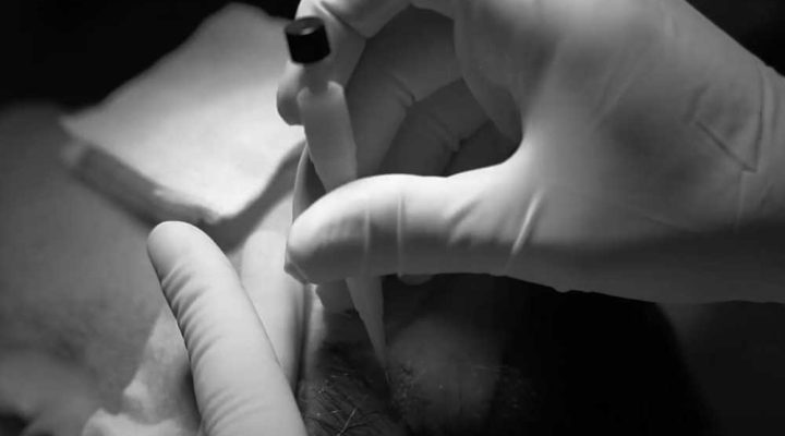 أحدث طرق زراعة الشعر بدون جراحة