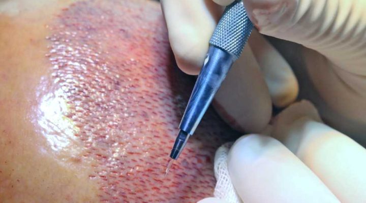 احدث تقنية لزراعة الشعر
