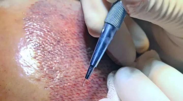 احدث تقنية لزراعة الشعر