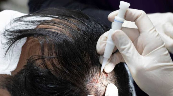 تقنية dhi لزراعة الشعر