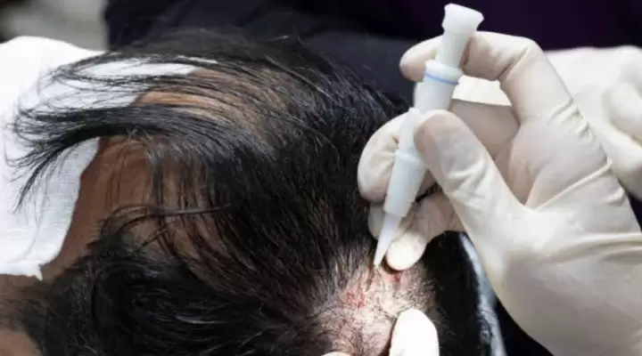 تقنية dhi لزراعة الشعر