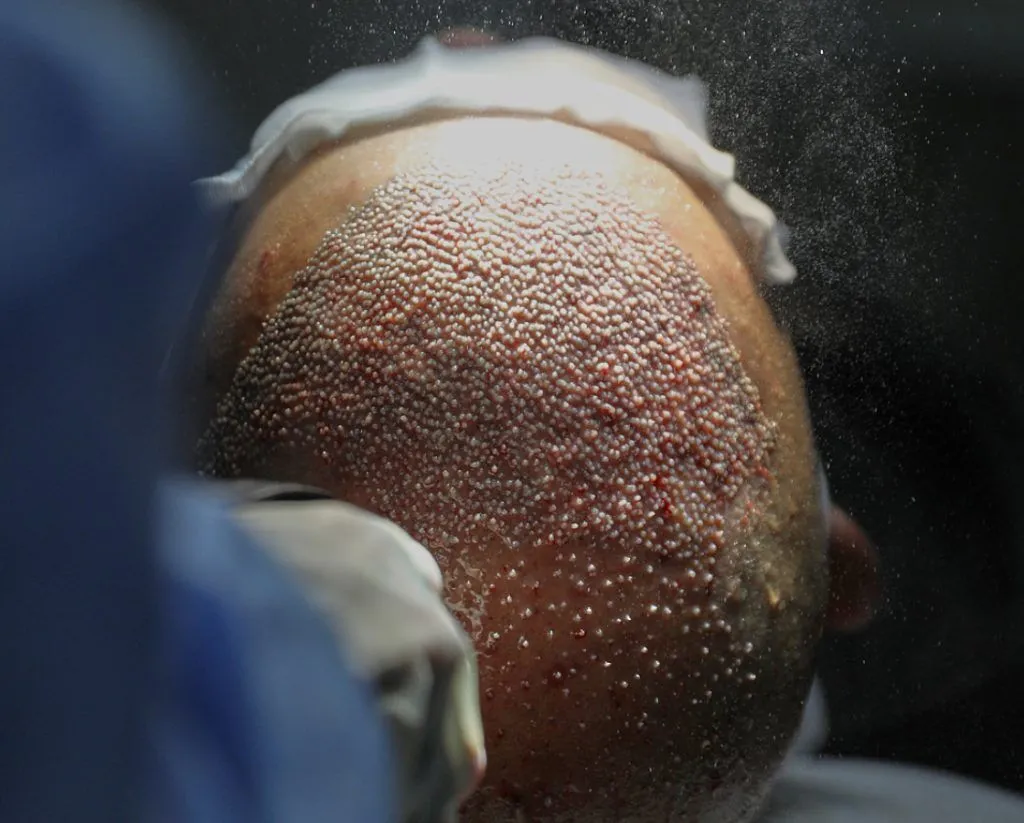 افضل مركز زراعة شعر في مصر 2026 تركي كلينك 6 زراعة الشعر بالاقتطاف FUE