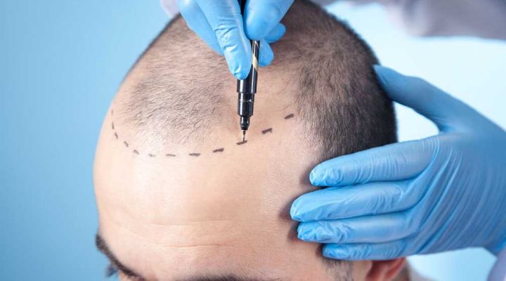 خطوات زراعة الشعر
