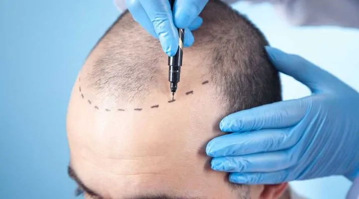 خطوات زراعة الشعر