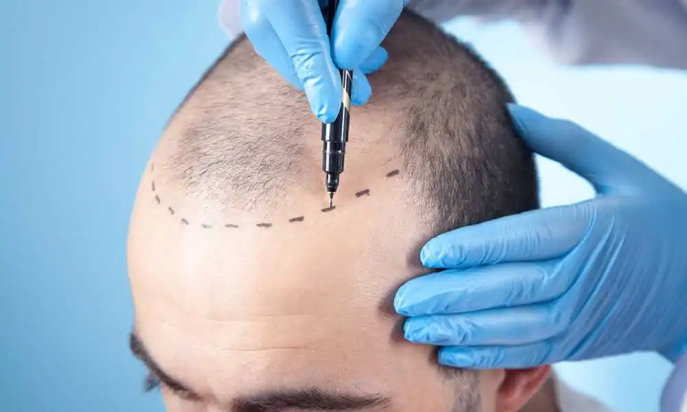 خطوات زراعة الشعر