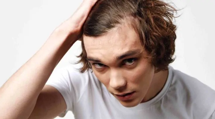 الصلع في سن العشرين