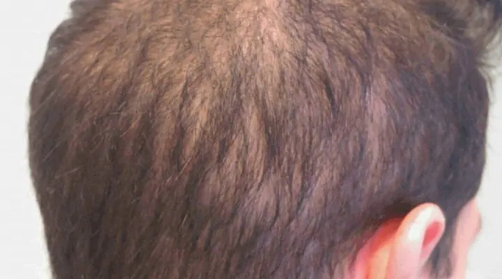 تساقط الشعر المنتشر (DUPA )