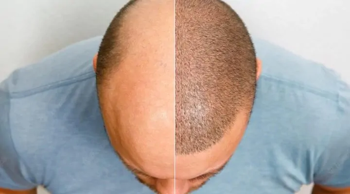 زراعة الشعر القنيات والإجراءات