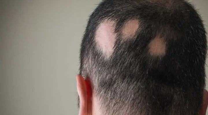 سبب فراغات الشعر المفاجئ