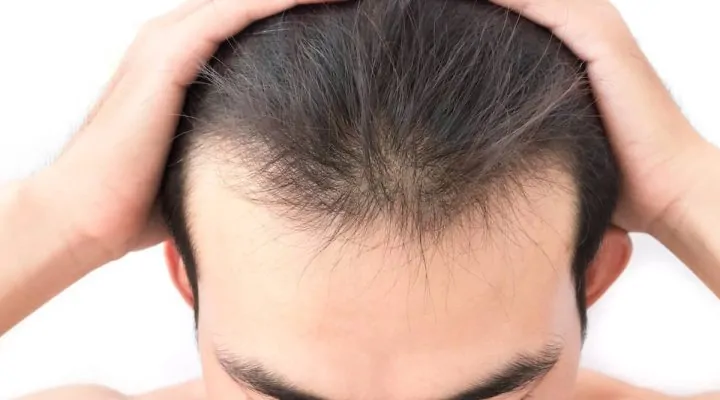 فشل عملية زراعة الشعر