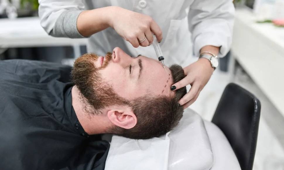 تخدير زراعة الشعر