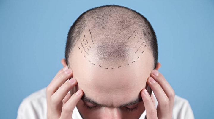 طريقة زراعة الشعر للرجال