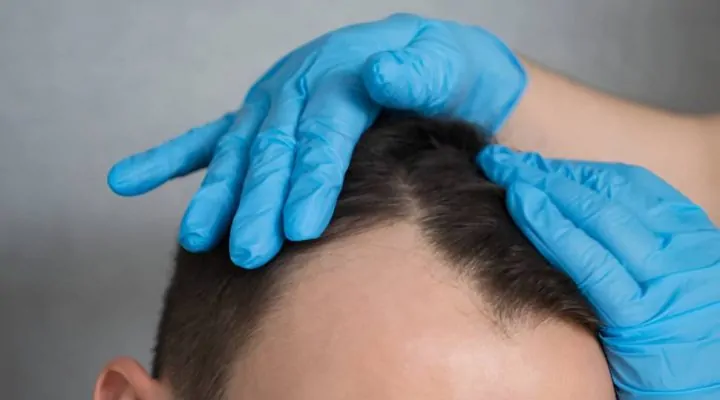 ما هي تقنية السفير لزراعة الشعر؟ 1