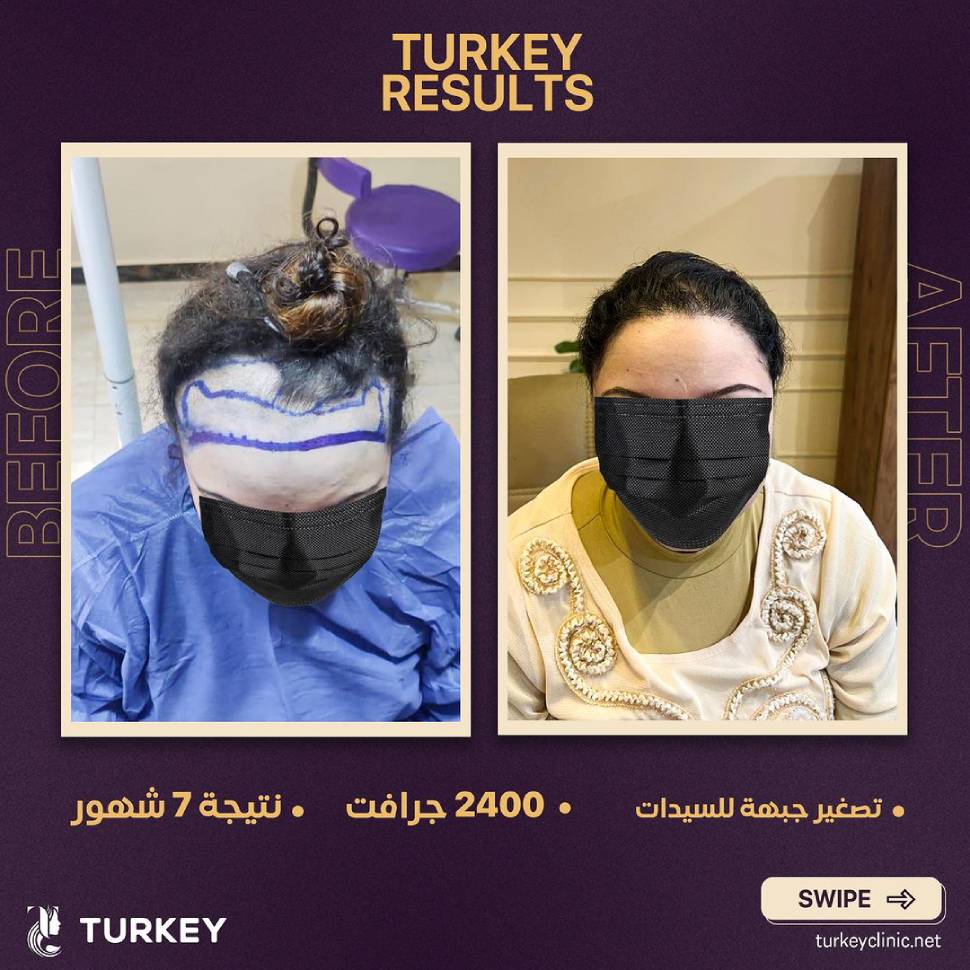 نتائج زراعة الشعر للنساء