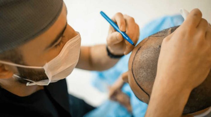 احدث طريقة لزراعة الشعر