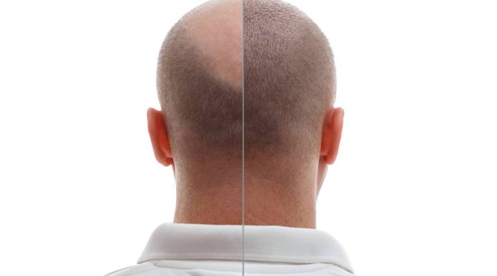 تقنية زراعة الشعر بالخلايا الجذعية