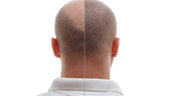 تقنية زراعة الشعر بالخلايا الجذعية