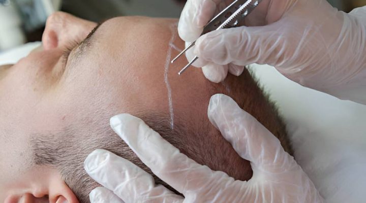 حالات زراعة الشعر 1