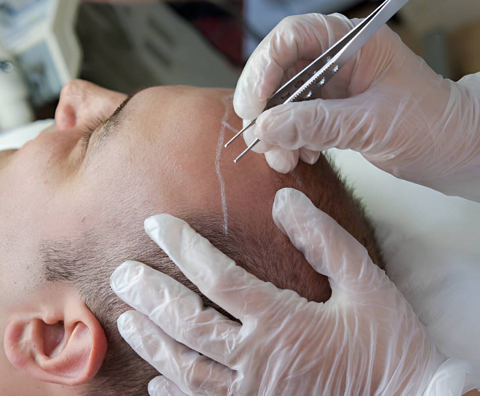 حالات زراعة الشعر 1