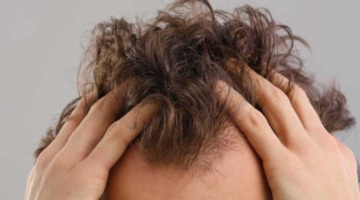 مميزات وعيوب زراعة الشعر