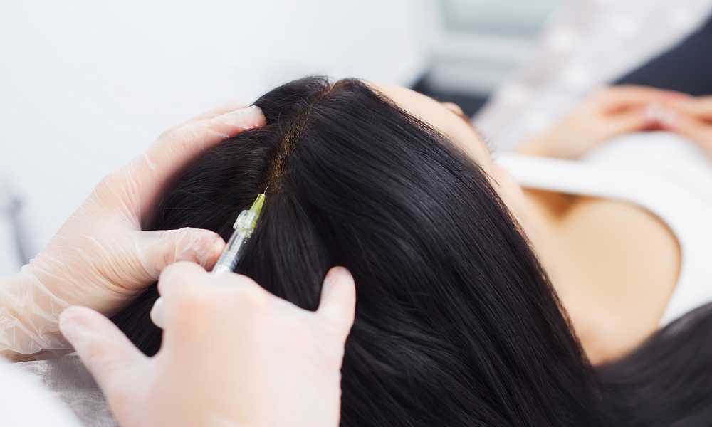 بدائل زراعة الشعر