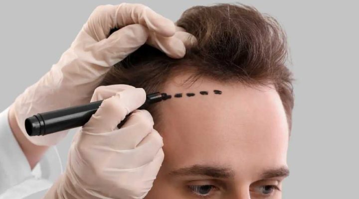 زراعه شعر قبل وبعد
