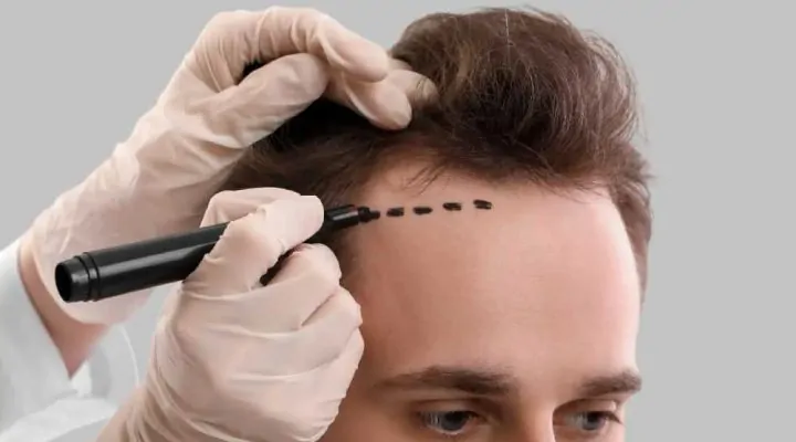 زراعه شعر قبل وبعد