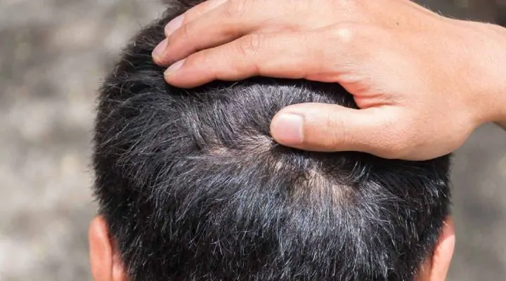 عملية زراعة الشعر بالاقتطاف