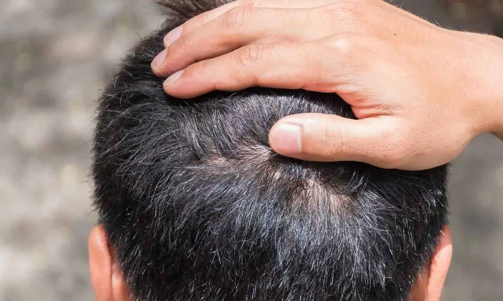 عملية زراعة الشعر بالاقتطاف