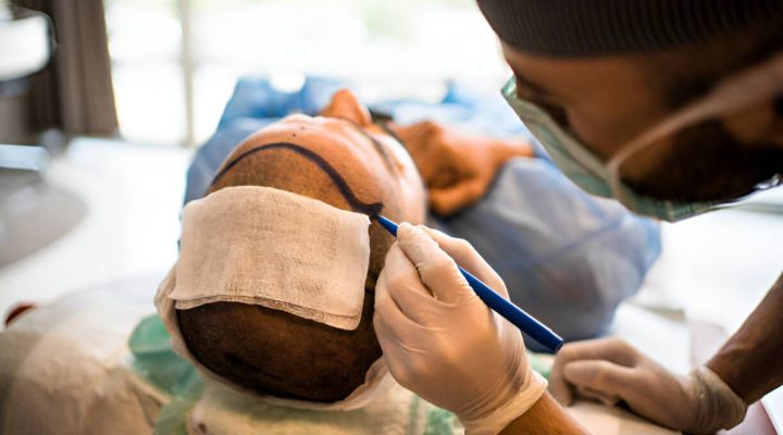 التعافي بعد زراعة الشعر