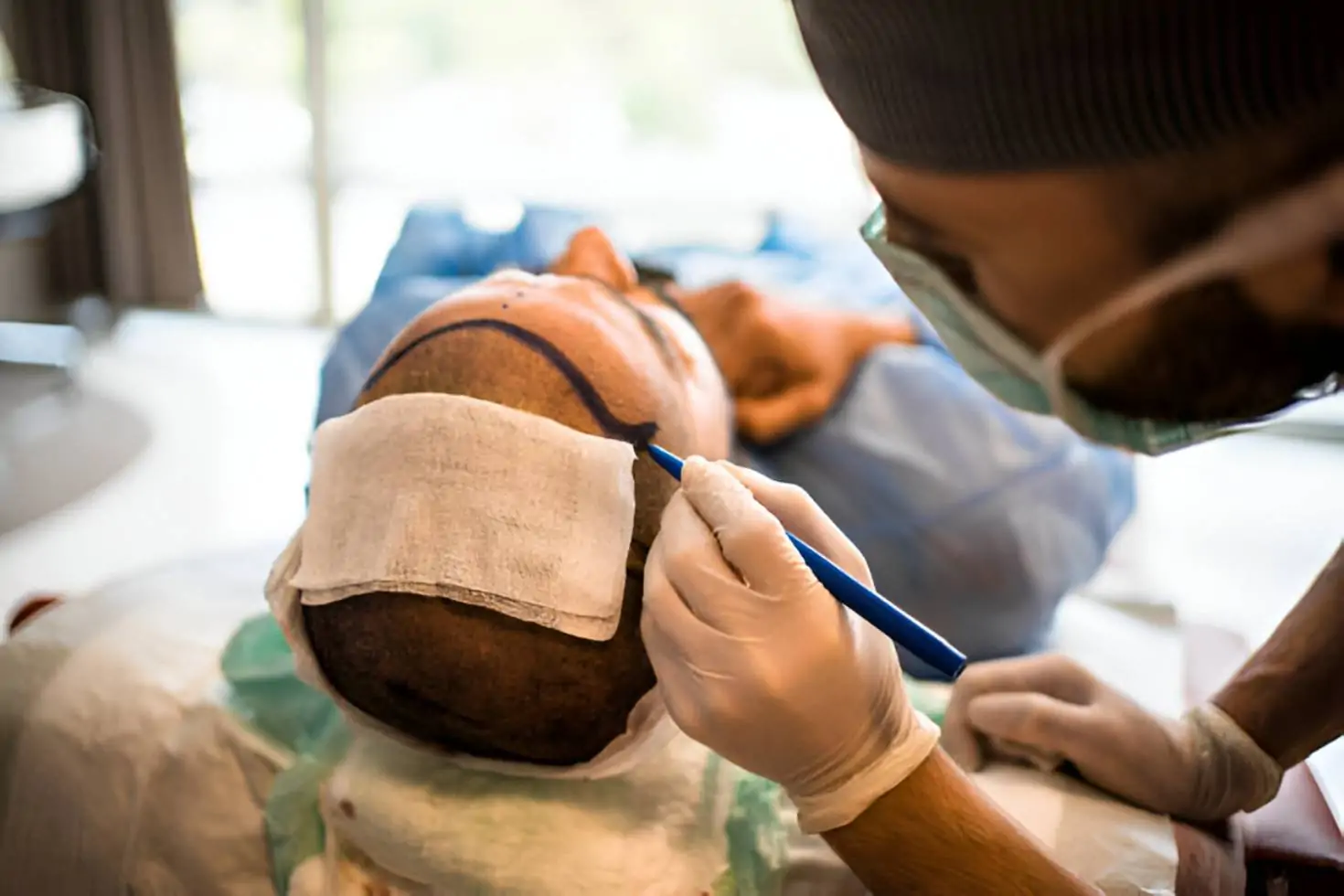 التعافي بعد زراعة الشعر